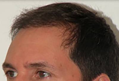 NeoGraft Patient Forehead After Treatment