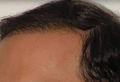 NeoGraft Patient Hairline After Treatment