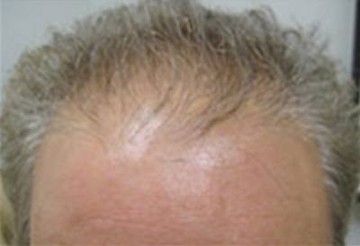 NeoGraft Patient Front Forehead Before Treatment