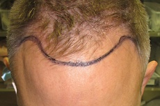 Before NeoGraft