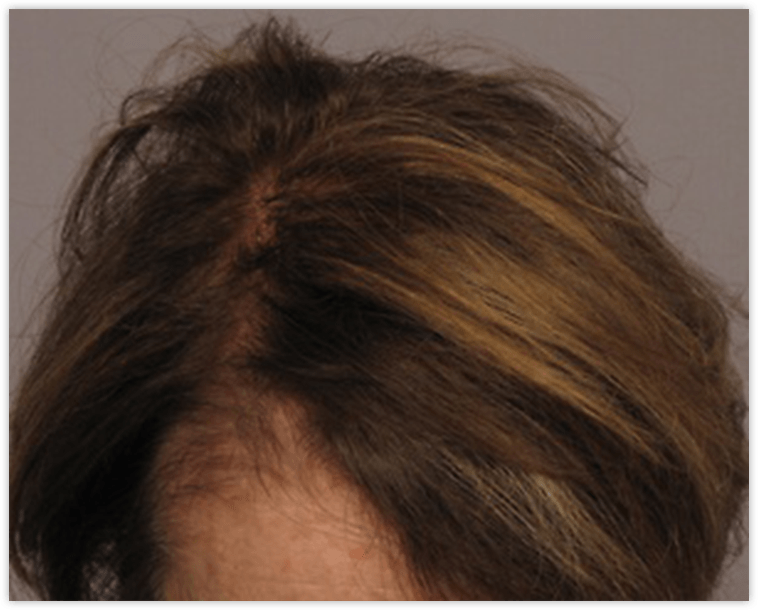 Female Patient After Smartgraft