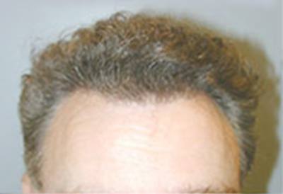 Real Patient After SmartGraft Treatment