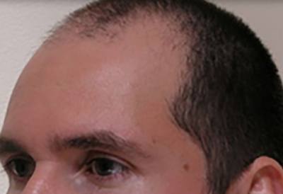 SmartGraft Patient Forehead Before Treatment
