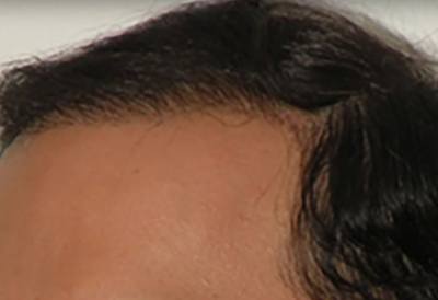 SmartGraft Patient Hairline After Treatment