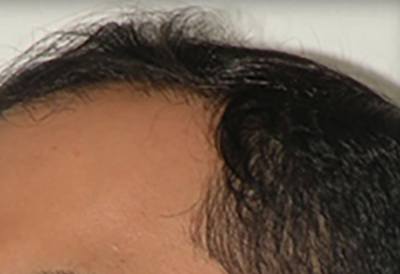 SmartGraft Patient Hairline Before Treatment