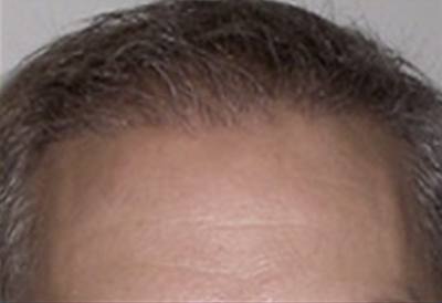 SmartGraft Patient Front Forehead After Treatment