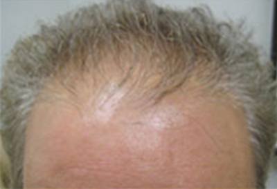 SmartGraft Patient Front Forehead Before Treatment