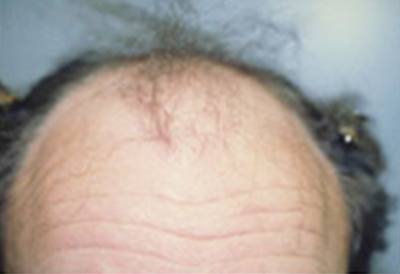 NeoGraft Patient Before Treatment Bald